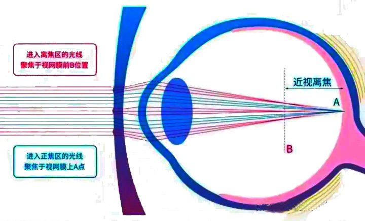 近视防控——近视防控手段有哪些？